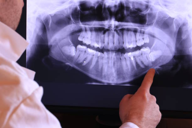 Best Emergency Wisdom Teeth Removal in Finley, WA