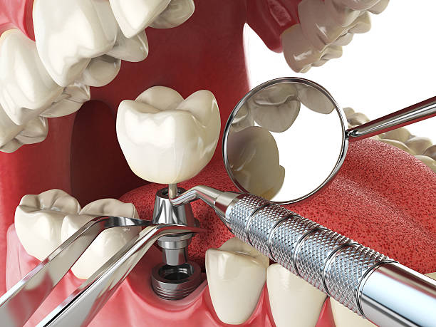 Best Emergency Dental Care for Broken or Chipped Teeth in Finley, WA